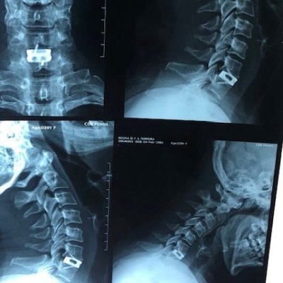 Artrodese cervical via anterior